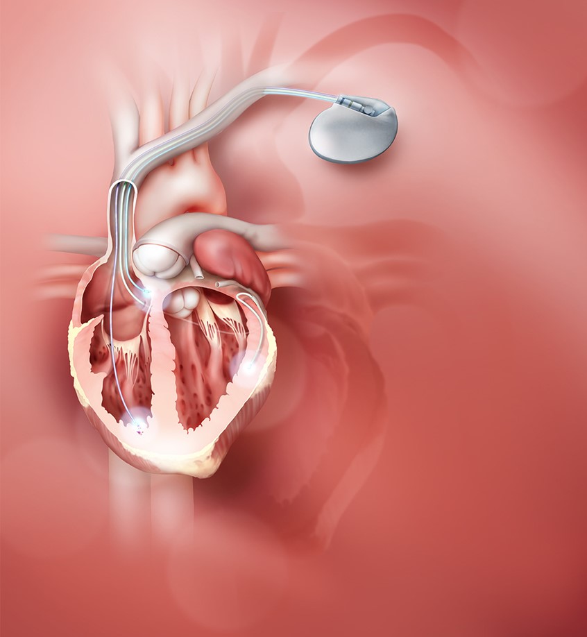 medical illustration of The pacemaker is a small electronic device, implanted in the chest to help regulate heart function. Cross-section of the heart showing the electrical pathways, atrium, mitral valve, aortic valve, pulmonary valve, aorta, vena cava, tricuspid valve and ventricles.
Medical artist, health illustrations, surgery and Healthcare.