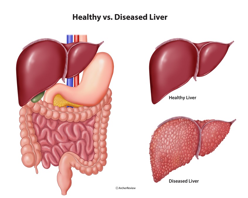 medical illustration of A healthy liver vs a liver with cirrhosis.
Keywords: liver, intestines, stomach, cirrhosis