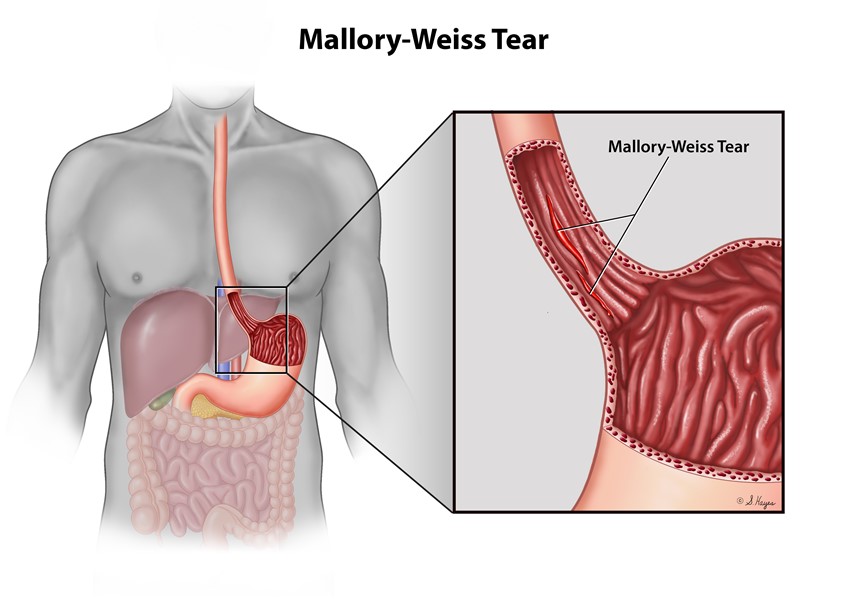 medical illustration of A Mallory-Weiss tear is a split in the inner lining of the esophagus, usually close to where it connects to the stomach. The primary cause is forceful vomiting or severe coughing. Most tears heal on their own.
Keywords: stomach, esophagus