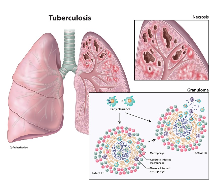 medical illustration of Tuberculosis (TB) is a contagious, airborne bacterial infection. It spreads through tiny droplets when an infected person coughs, sneezes, or speaks.
Keywords: lungs, tuberculosi