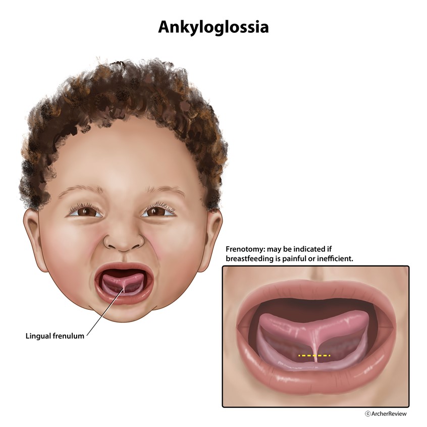 medical illustration of Ankyloglossia, commonly called tongue-tied, is a congenital condition where the lingual frenulum is unusually short, thick, or tight. This limits the tongues range of motion and can affect feeding and speech.
Keywords: tongue, mouth, baby