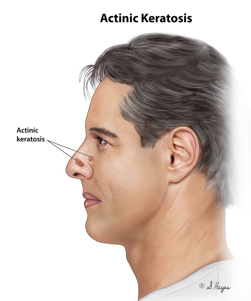 medical illustration of Actinic keratosis is a pre-cancerous area of thick, scaly, or crusty skin. It is a disorder of epidermal keratinocytes that is induced by UV light exposure.
Keywords: skin diseases, cancer, skin