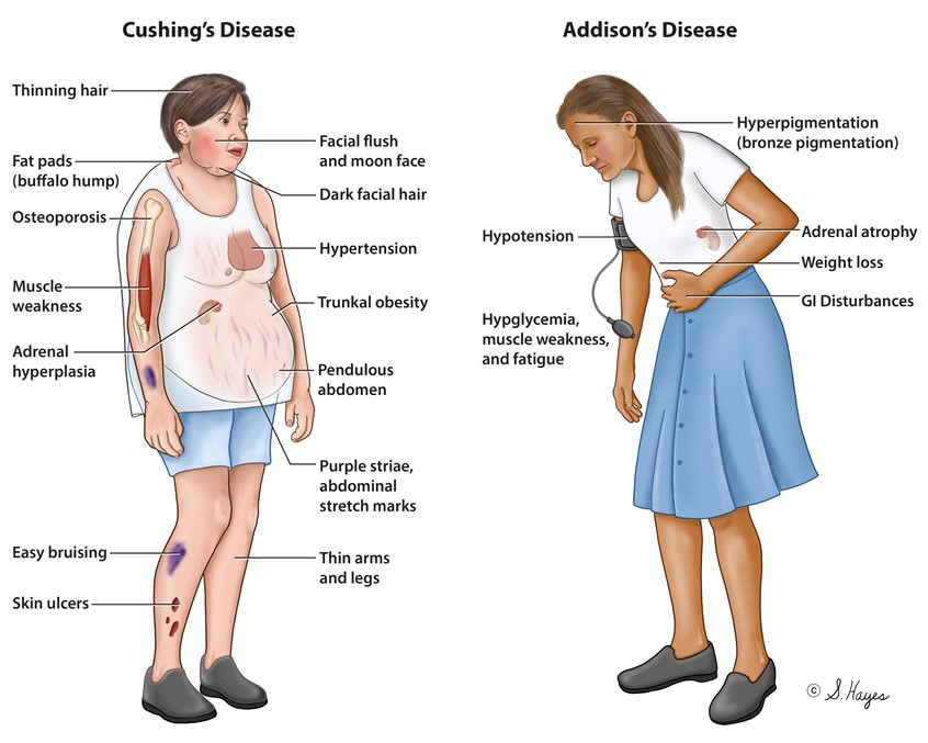 medical illustration of Cushing's Disease and Addison's Disease;
Cushing's Disease involve an excess of cortisol, often due to a pituitary tumor or long-term steroid use. It