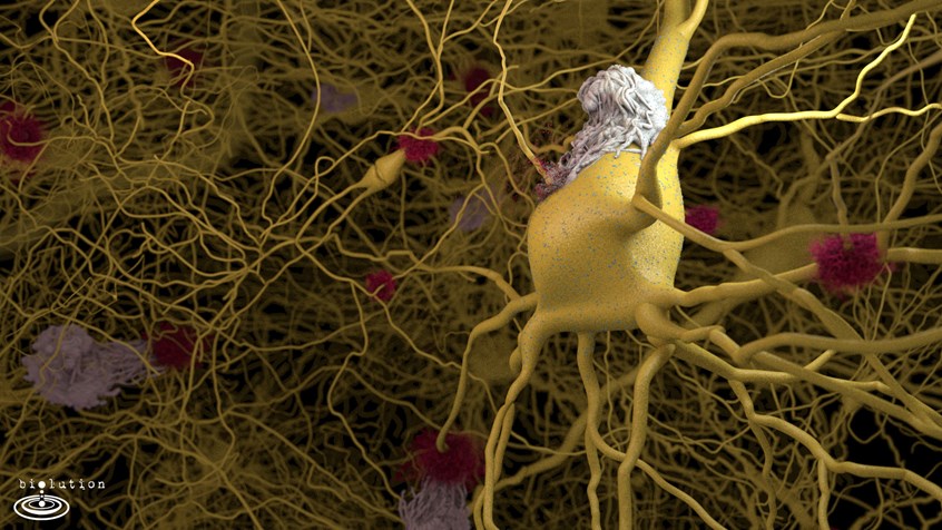 medical illustration of Wrongly folded Alpha-Synuclein similar to prions agglutinates, breaks through the cell wall and infects other neurons which results in the death of dopamine producing cells giving the starting shot to Parkinson’s Disease. In this picture, the disease already spread through the tissue but through a previous vaccination Macrophages attack the aggregates and stop further infection of healthy cells.