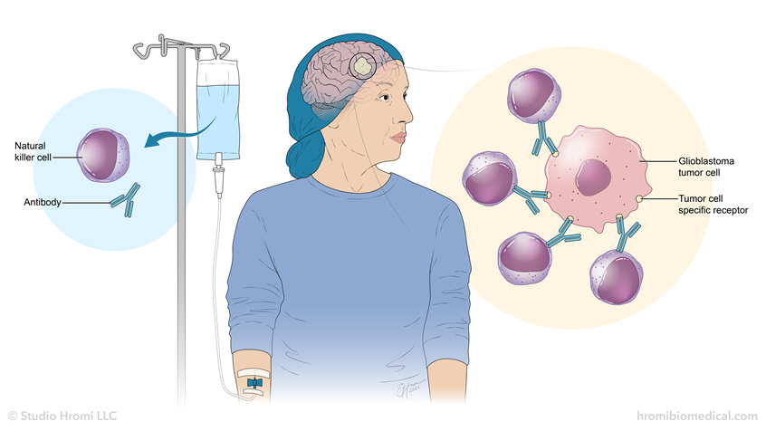 medical illustration of Simple flat-color illustration of a patient receiving a novel treatment for glioblastoma, which uses NK cells and antibodies to specifically target the tumor.