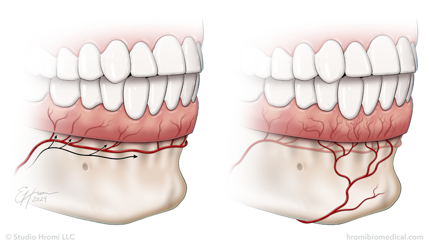 medical illustration of Side-by-side illustration of the vessels that supply the gingiva of the lower jaw; on the left, the oblique course of the inferior labial artery branches to form a circulatory network in the lower gingiva, and on the right the submental artery branches to form superficial sub-branches with a complex pattern of anastomoses (with a large proportion directed toward the canine and lateral incisor papilla).
