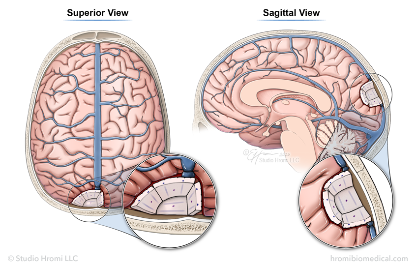 medical illustration of A neuro anatomy illustration showing the placement of GammaTiles for a unique case involving partial removal of the superior sagittal sinus.