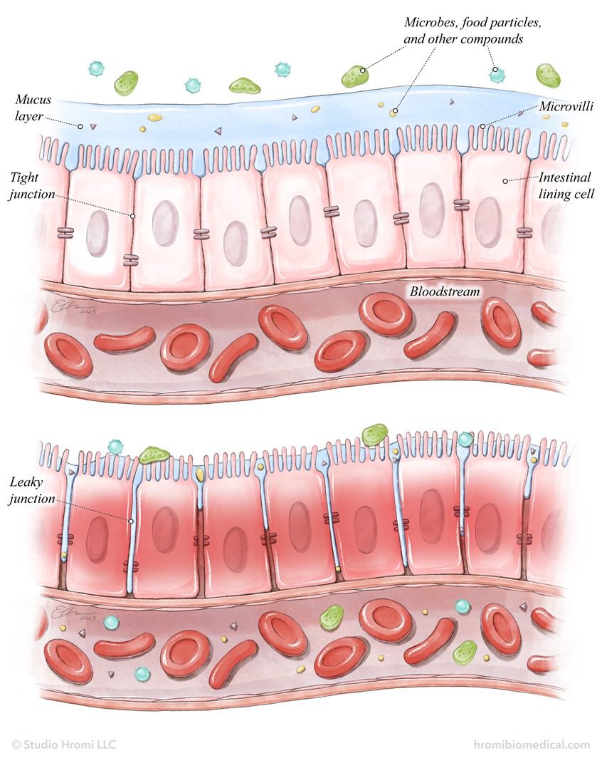 medical illustration of A watercolor-style illustration showing tight junctions between the cells of the intestinal lining and leaky junctions leading to inflammation and gut damage. Illustrated for