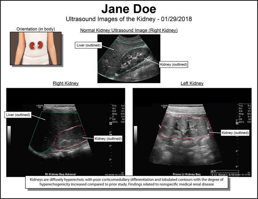 medical illustration of Renal Ultrasound showing diffusely hyperechoic kidneys with poor corticomedullary differentiation and hyperechogenicity. Medical renal disease