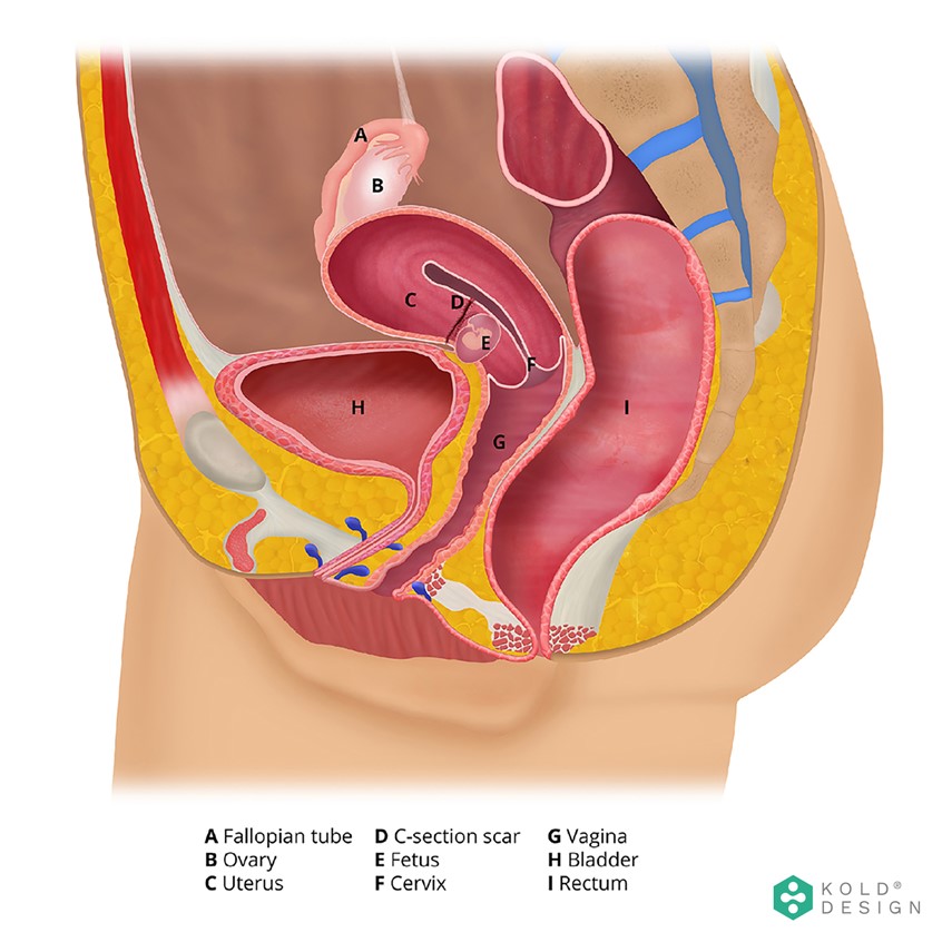medical illustration of A Caesarean section is the delivery of a baby through a surgical incision in the abdomen and uterus. This illustration represents its anatomy and it was done in Adobe Photoshop.