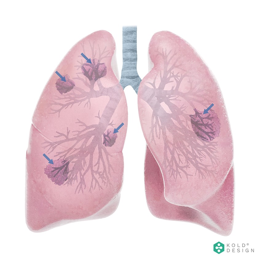 medical illustration of SARS-CoV-2 leads to damage of lung tissue. This illustration was made using Adobe Illustrator and Photoshop based on chest CT scans in patients with COVID-19–associated pneumonia.