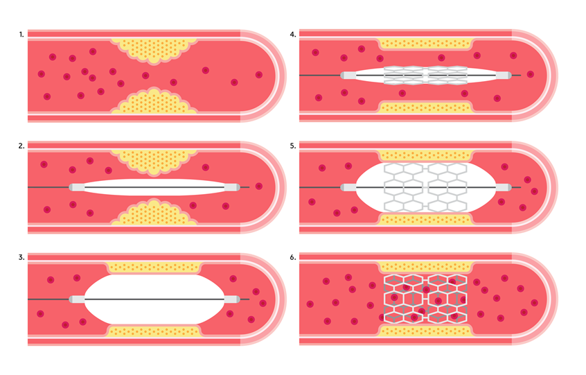medical illustration of Illustration of a stent being inserted in an angioplasty procedure. Cardiology, artery, stent, operation, catheter, balloon, fatty deposit, coronary, vessel, blood, peripheral vascular disease, coronary artery disease, iliac, femoral, vector graphic, educational, learning, diagram, user interface, animation, surgery, e-learning, worksheet, workbook, remote learning, text book.