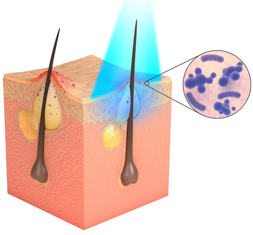 medical illustration of Series of visuals to show mechanism of action in acne, this one - Blue light MOA – antibacterial action on porphyrins