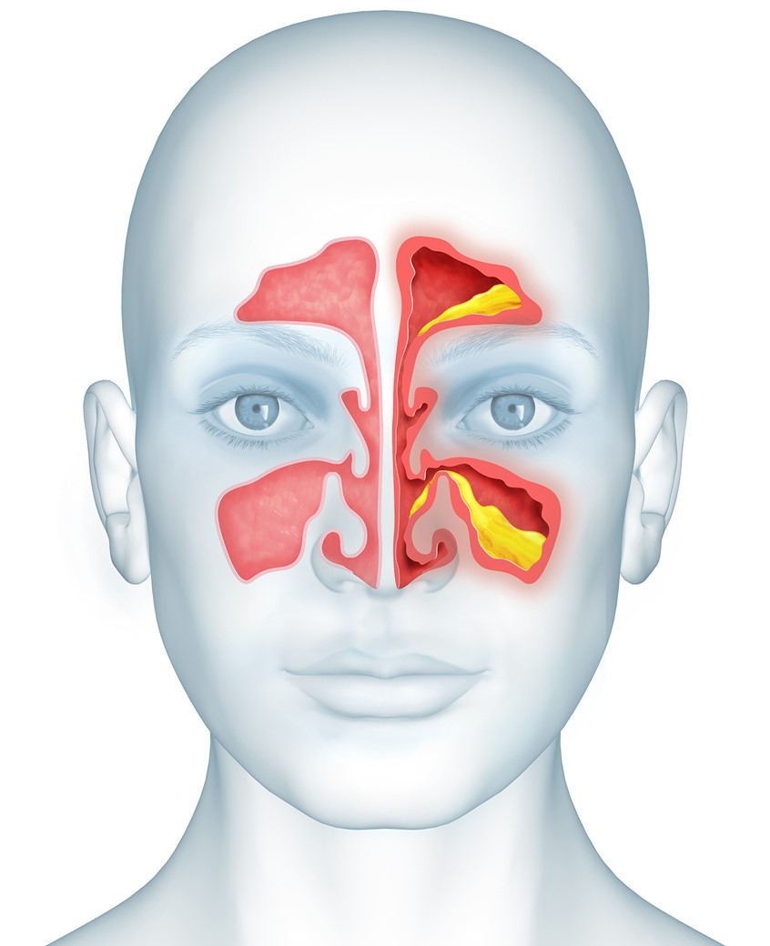medical illustration of Visual to show key symptoms of a head cold for Johnson & Johnson