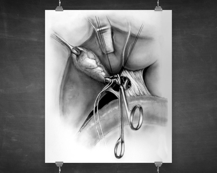 medical illustration of This piece shows the bisection of the cystic artery, prior to the surgical removal of the gall bladder.
The rendering technique, carbon dust application, while somewhat antiquated, produces lovely warm continuous tone images that are difficult to replicate, even digitally, and is a hallmark of classical medical illustration.