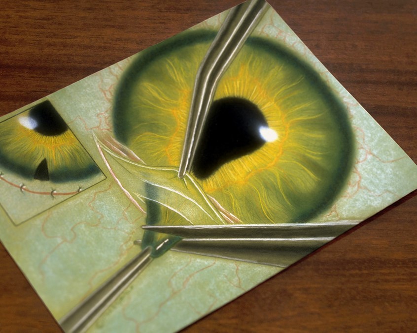 medical illustration of A treatment for glaucoma to reduce pressure within the eye, this illustration is the second of a two part series. This is a typical manner of rendering surgical procedures for use in instructional media, patient education or pharmaceutical marketing.
