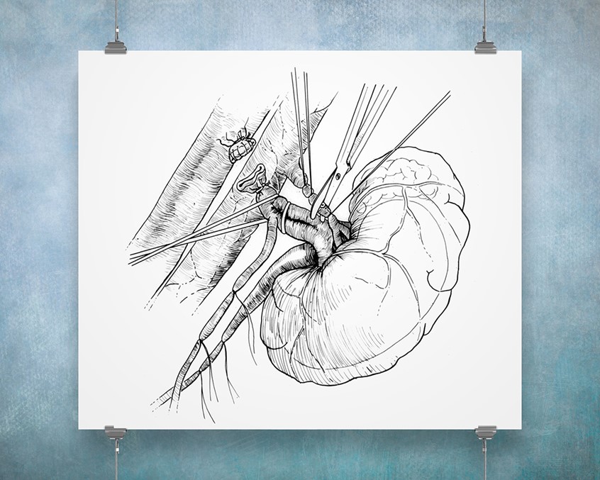 medical illustration of Surgical illustration is a classic discipline. One of the more interesting surgeries observed, the physical removal of a kidney, was photographed, sketched and then rendered as a one-page plate in pen and ink.