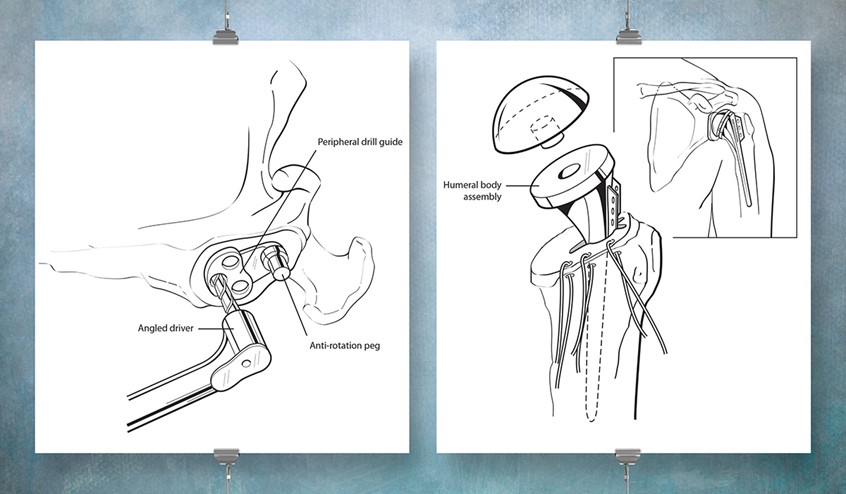 medical illustration of This piece, the surgical replacement of the humeral head and the glenoid process, is part of a multistage surgical procedure. The finished work was selected for exhibition to demonstrate that line work need not be done in the traditional manner of pen and ink alone, as digital tools could be just as effective.
