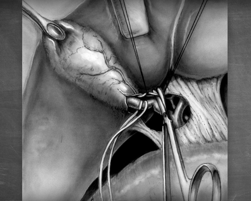 medical illustration of This piece shows the bisection of the cystic artery, prior to the surgical removal of the gall bladder.
The rendering technique, carbon dust application, while somewhat antiquated, produces lovely warm continuous tone images that are difficult to replicate, even digitally, and is a hallmark of classical medical illustration.