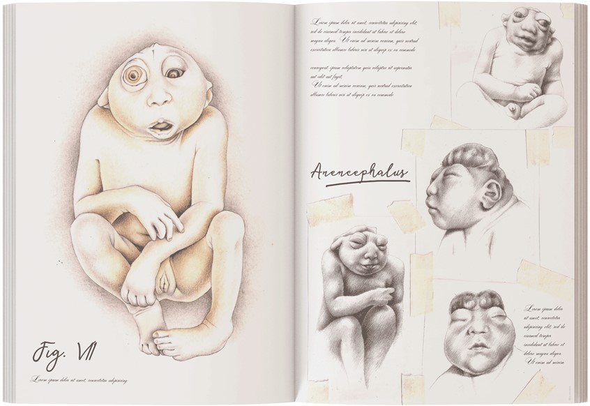 medical illustration of Anatomical studies on anencephalic foeti wet specimen.
(Foetus. Anencephaly. Anatomical Illustration. Anatomy. Scientific Visualization. Biology. Anatomy. Pathology. Obstetrics. Gynecology. Malformation. Maternal. Child. Education. Research. Abnormality. Physiology. Morphology. Teratology. Medical Illustration. Embryology. Realism. Drawing)