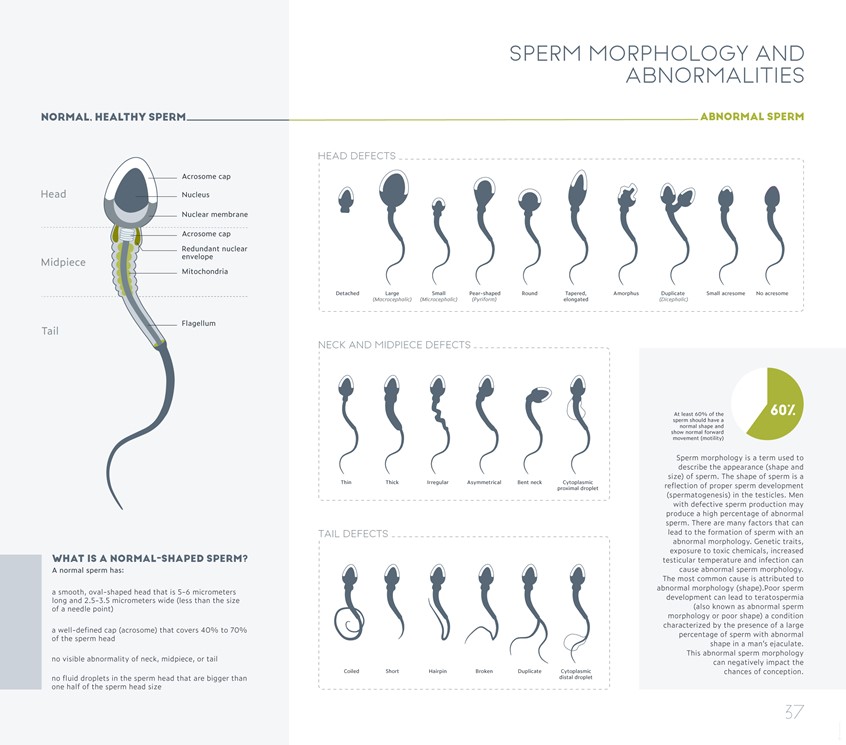 medical illustration of Graphical chart and illustrations on morphology and abnormalities of human sperm, accompanied by explanatory scientific information.
(Medical Illustration. Medical Visualisation. Anatomy. Morphology. Malformation. Abnormality. Urology. Pathology. Biology. Physiology. Illustration. Infographic. Information graphic. Education. Research. Chart. Informational. Graphic Design. Vector graphic. Editorial.)