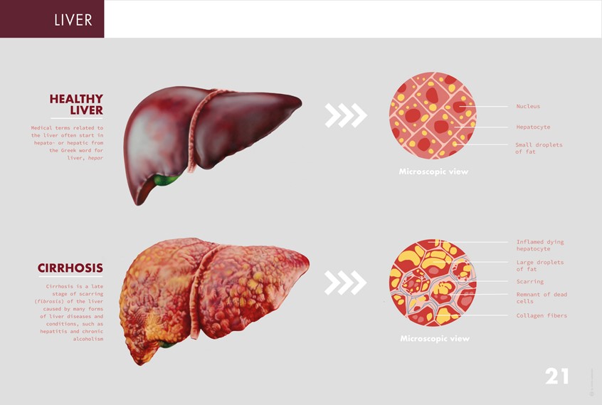 medical illustration of Medical illustration depicting the differences between a healthy liver and one with cirrhosis
(Medicin. Medical Illustration. Scientific visualisation. Science. Anatomy. Morphology. Pathology. Liver. Cirrhosis. Infographic. Information graphic. Education. Research. Organs. Health. Disease. Chart. Editorial. Realism. Drawing. Art. Vector graphic. Graphic design. General Medicine. Editorial)