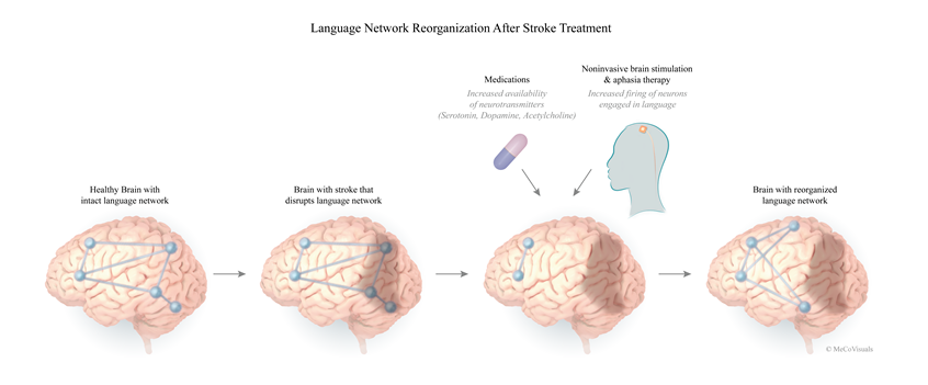 medical illustration of This image (one of a series of four total images) highlights the mechanism underlying a provider's decisions to implement combination treatment modalities to improve aphasia symptoms in the brain of a patient with a left hemisphere stroke.