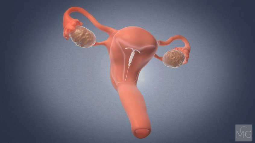 medical illustration of Final model of a cross-sectional uterus featuring an intrauterine device, or IUD. This model was incorporated into a 3D animation for the Women's Health department in Dell Medical School at The University of Texas.