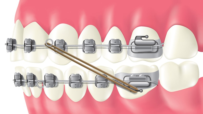 medical illustration of F/C illustration of dental braces, digital image, 3D, 3D character, Photoshop image, photo-realism, realistic images, retouching 3D imaging, images of cutaways, technical images, science, scientific images, vector images, product images, medical, pharmaceutical, conceptual images, humor, animals, dinosaurs, landscapes, fantasy, people, corporate, book covers, magazines, fantasy.