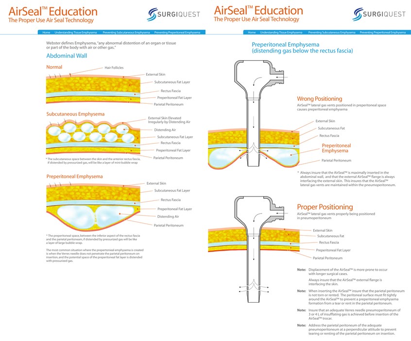 AirSeal Trocar Illustration by N. Lee Wade | Medical Illustration ...