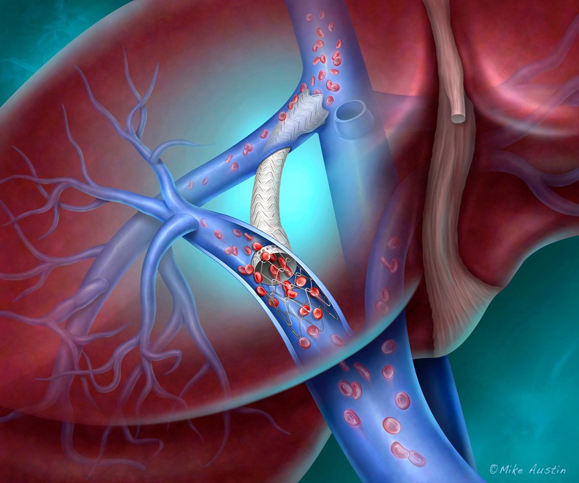medical illustration of A TIPS (Transjugular Intrahepatic Portosystemic Shunt) procedure is a minimally invasive treatment for portal hypertension, a condition where blood pressure in the portal vein is abnormally high, often due to liver disease.