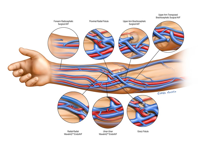 medical illustration of This medical illustration presents the vascular anatomy of the upper extremity with detailed insets highlighting common arteriovenous (AV) fistula configurations and surgically transposed vessels used to establish hemodialysis access. The primary image depicts the arterial and venous structures of the arm in anatomical context, while enlarged inset panels demonstrate specific fistula locations and vessel transpositions with precision and clarity.