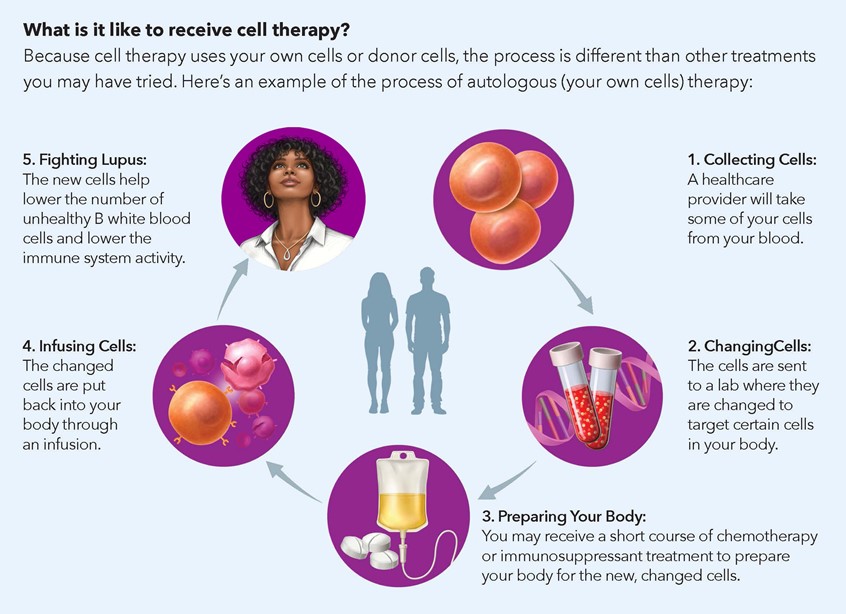 medical illustration of This five-step illustration of lupus cell therapy visually explains the process of immune cell collection, modification, and reinfusion to treat autoimmune disease. Designed for clarity and accuracy, it transforms complex immunology into an accessible and engaging visual.