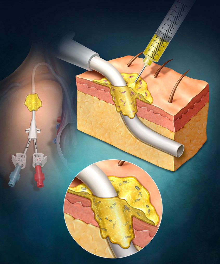medical illustration of This illustration highlights a catheter insertion site in the chest, emphasizing both anatomical accuracy and infection prevention strategy. The catheter is shown entering the skin and advancing into the underlying vasculature, with careful attention to surrounding tissue layers and placement. At the point of entry, a specialized antimicrobial gel is applied over the skin surface, demonstrating its role as a protective barrier against bacterial contamination.