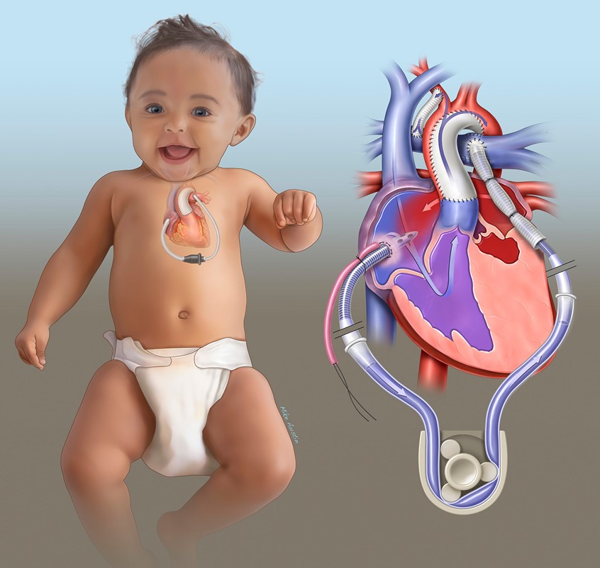 medical illustration of These medical illustrations were created in collaboration with a pediatric surgeon to support journal articles focused on the surgical treatment of hypoplastic left heart syndrome (HLHS). The illustrations depict ventricular assist devices (VADs) placed following the Norwood procedure.