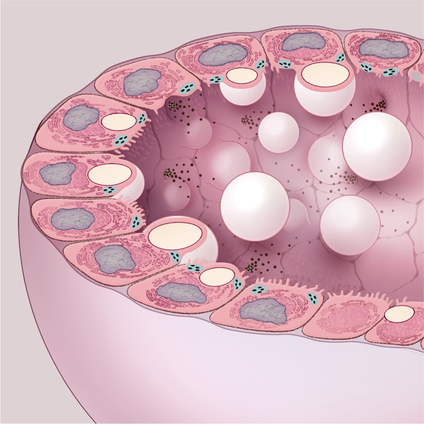medical illustration of This image depicts the alveolus of a lactating mammary gland. The lactocyte, the primary epithelial cell, synthesizes lipid droplets and casein granules, essential for breast milk. The alveolar lumen is filled with these secretory products, illustrating lactation function. Eccrine secretion contributes to milk composition. This representation is valuable for medical training and patient education on lactation physiology. © Hrejsa Medical Media.