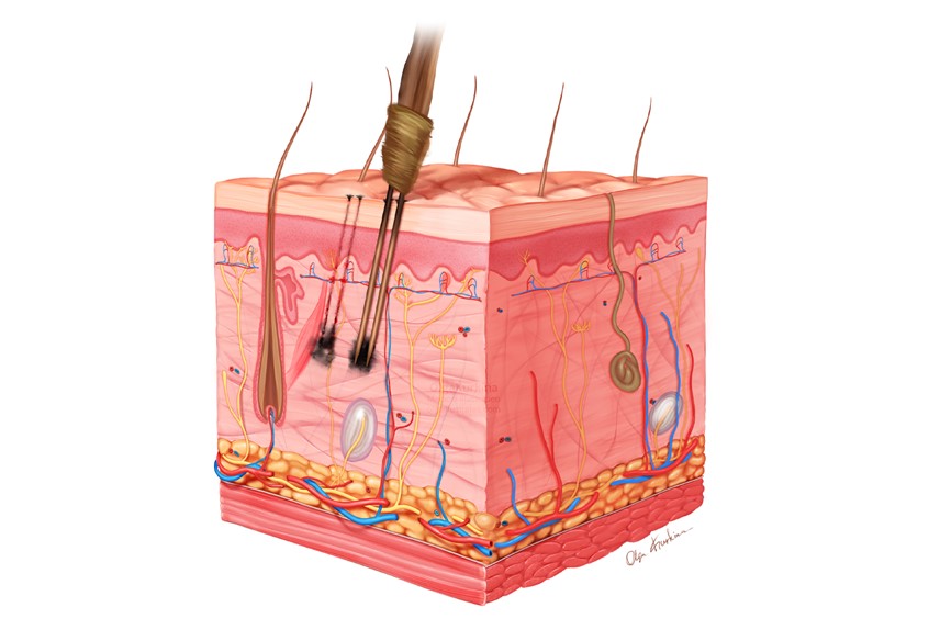 medical illustration of Medical illustration showing a cross-section of human skin during the tattooing process using a traditional hand-poked tattoo tool.
The image illustrates manual puncture of the dermal layer with sharpened sticks to deposit pigment, explaining the biological basis of permanent tattoo formation.
Created for Jagiellonian University.