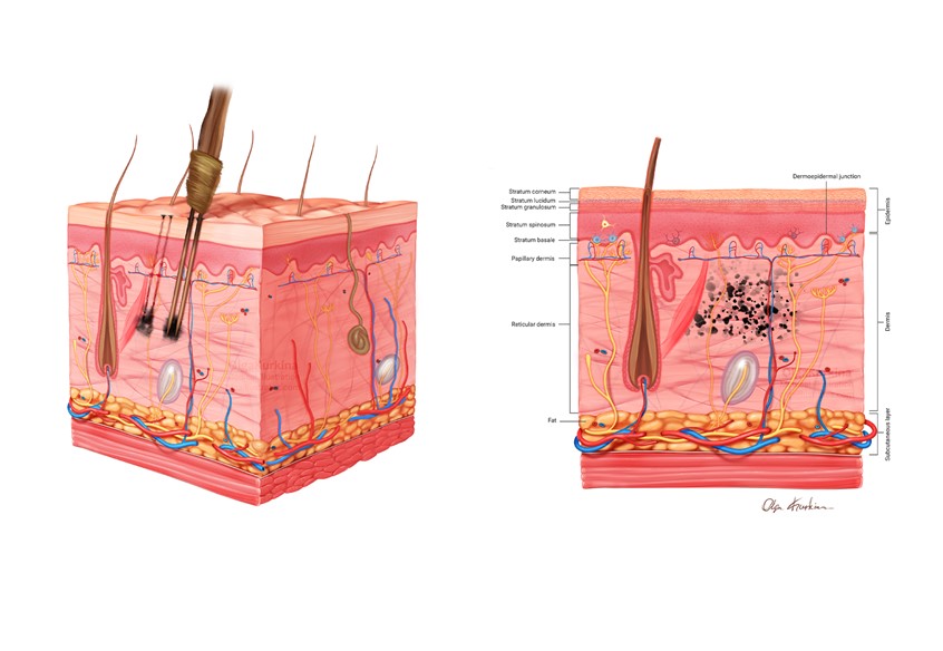 medical illustration of Medical illustration showing a cross-section of human skin during the tattooing process using a traditional hand-poked tattoo tool.
The image illustrates manual puncture of the dermal layer with sharpened sticks to deposit pigment, explaining the biological basis of permanent tattoo formation.
Created for Jagiellonian University.