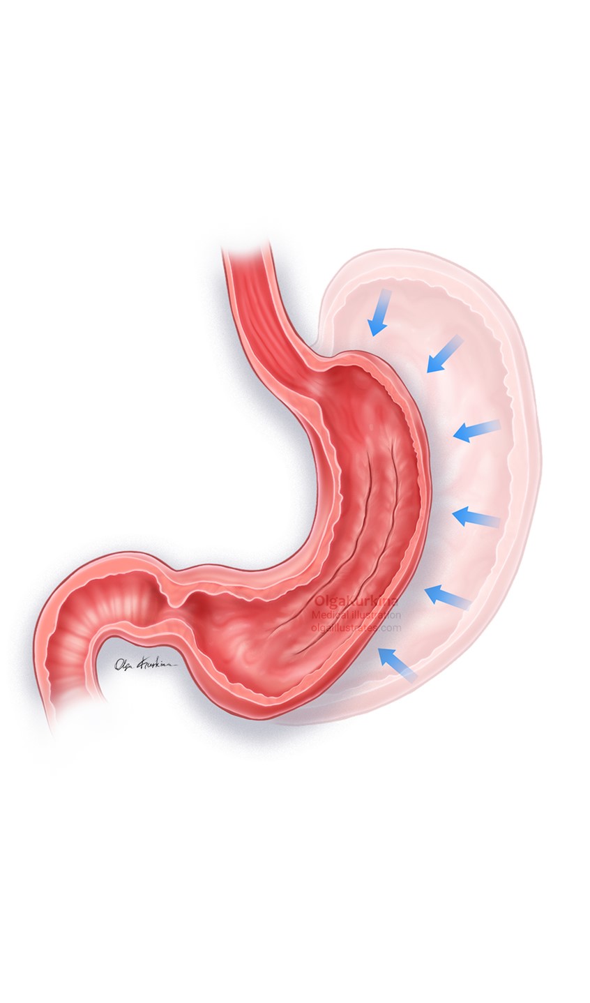 medical illustration of Medical illustration showing the post-procedure anatomy of the stomach after Endoscopic Sleeve Gastroplasty (ESG) combined with Gastric Fundal Mucosal Ablation (GFMA), highlighting reduced gastric volume, suturing pattern, and altered fundal lining to support weight loss.
Illustration created for Daniel B. Maselli, M.D. Mayo Clinic