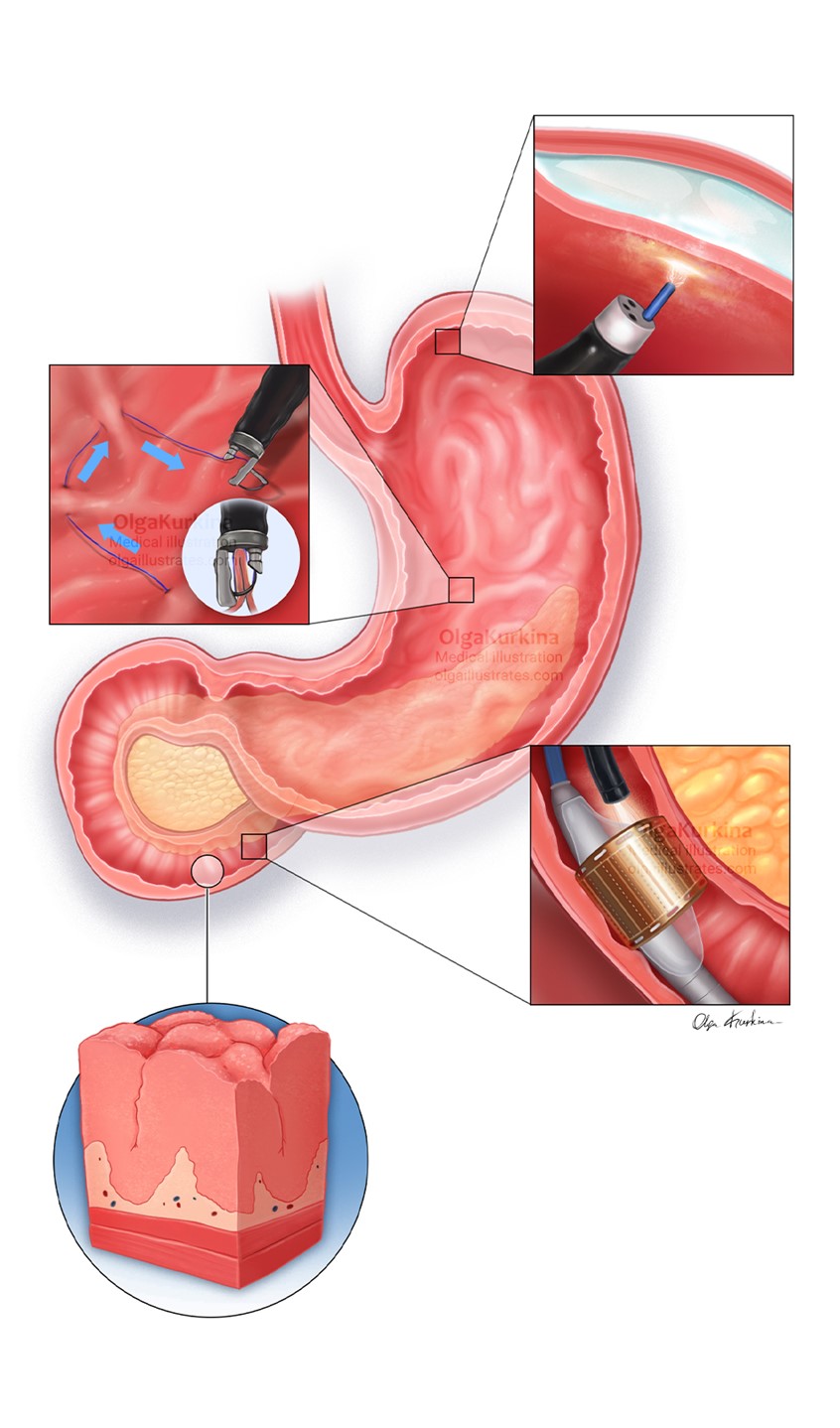 medical illustration of Medical illustration showing obesity endoscopic treatments: Endoscopic Sleeve Gastroplasty (ESG), gastric fundal mucosal ablation, and duodenal re-cellularization, highlighting anatomical changes and therapeutic mechanisms for weight management.
Illustration created for Daniel B. Maselli, M.D. Mayo Clinic