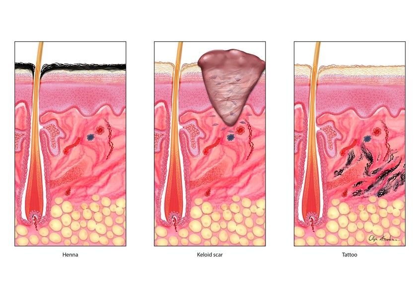 medical illustration of The medical illustration shows the histology of skin for three different types of decoration: henna staining, scarification with keloid formation, and tattooing after healing.
The illustration shows which skin layers are affected by each type of treatment, as well as the type of changes that occur in the skin. This illustration is intended for use in professional education materials.
