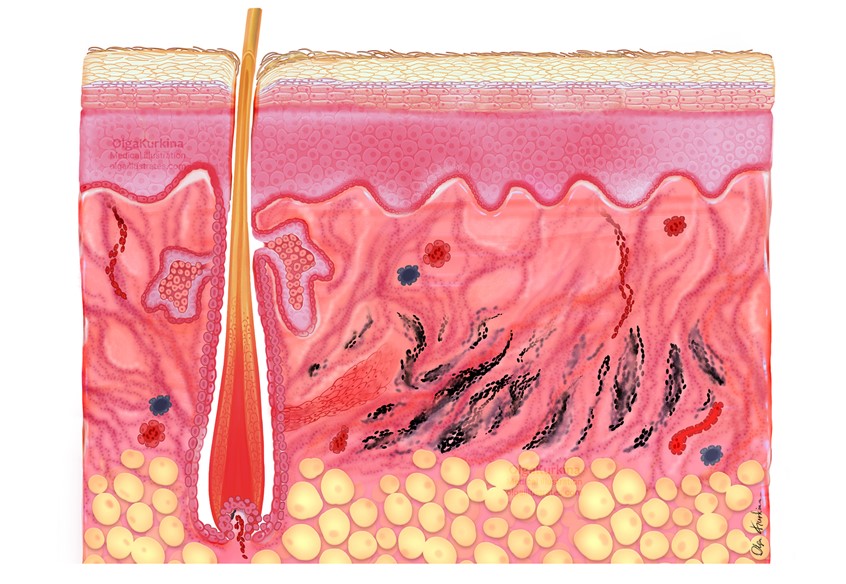 medical illustration of Medical illustration showing a cross-section of human skin after tattoo healing.
The image depicts the epidermis, dermis, and subcutaneous tissue, with stabilized pigment particles distributed within the dermal layer following the healing process.
Created for professional publication.