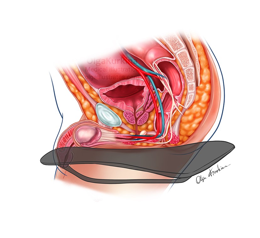 medical illustration of Medical illustration showing the specific effects of a classic bicycle saddle on the pelvic organs of professional male cyclists. In the illustration you can see the pressure zones and how they primarily affect blood vessels and nerves.
Created for James Parker, MD