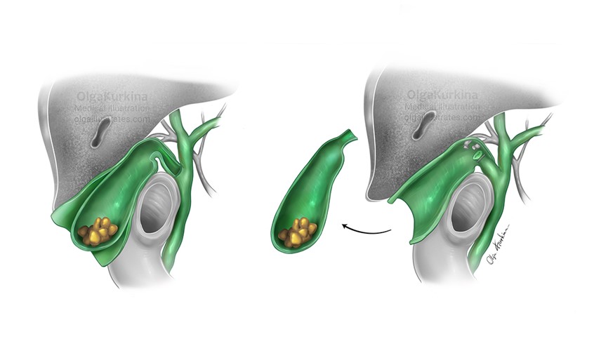 medical illustration of Medical illustration depicting the cholecystectomy procedure with clearly marked incision guides, showing anatomical landmarks and surgical access points for gallbladder removal.