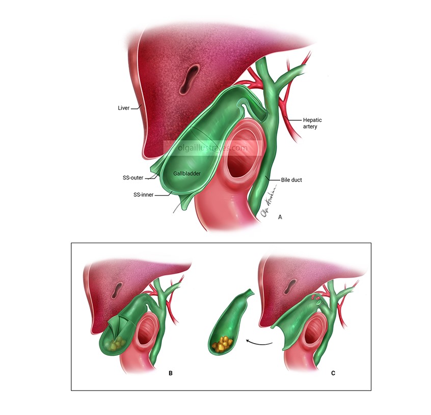 medical illustration of Subserosal cholecystectomy. A medical illustration I created last year depicts a subserosal cholecystectomy. It shows the surgical approaches and incision lines during the procedure.