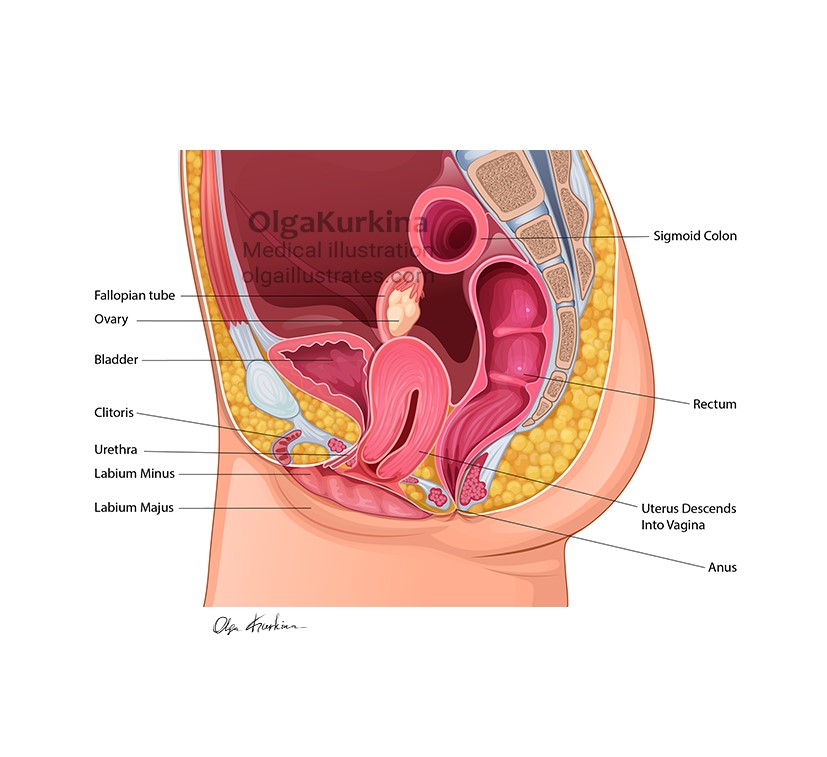 medical illustration of An anatomical vector illustration depicting the female pelvic organs in a case of uterine prolapse. This illustration was created for educational purposes to train specialists in postpartum recovery.
Created for Everyday Battles, LLC