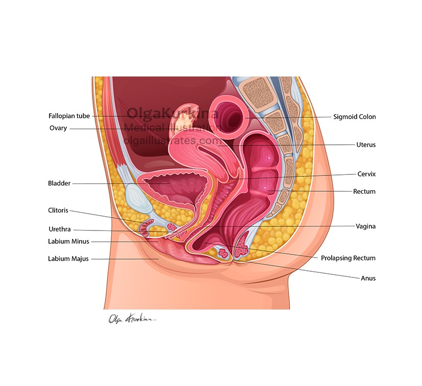 medical illustration of An anatomical vector illustration depicting the female pelvic organs in a case of Rectocele (Rectum Prolapse). This illustration was created for educational purposes to train specialists in postpartum recovery.
Created for Everyday Battles, LLC
