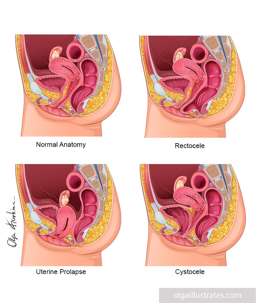 medical illustration of Anatomical vector illustration depicting the female pelvic organs in various types of organ prolapse, compared with normal anatomy.
This illustration was created for educational purposes to train specialists in postpartum recovery.
Created for Everyday Battles, LLC