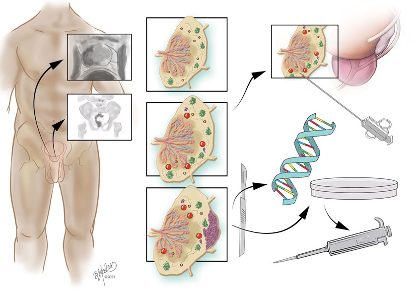 medical illustration of Path of PSMA - Prostate Specific Membrane Antigen- therapy targeting tumors in patients presenting with prostate cancer. The gray boxes are a general depiction of scans.