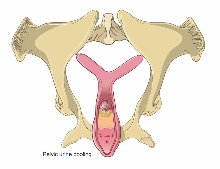 medical illustration of Editorial illustration showing a simple example of pelvic urine pooling in the anterior vagina of the equine mare. Urine pooling is a common, yet correctable cause of infertility.